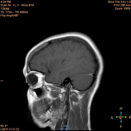File:Cerebellopontine angle meningioma (Radiopaedia 22488-22525 Sagittal T1 C+ 4).jpg