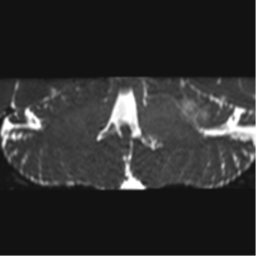Cerebellopontine angle meningioma (Radiopaedia 48434-53348 Coronal T2 28).png