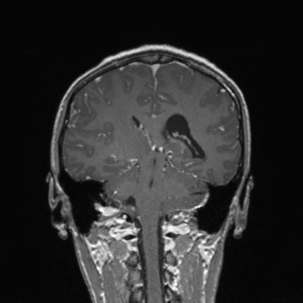 Cerebral abscess (Radiopaedia 24212-24478 Coronal T1 C+ 133).jpg