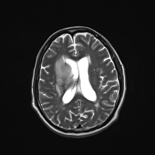 Cerebral abscess (Radiopaedia 26111-26247 Axial T2 38).jpg