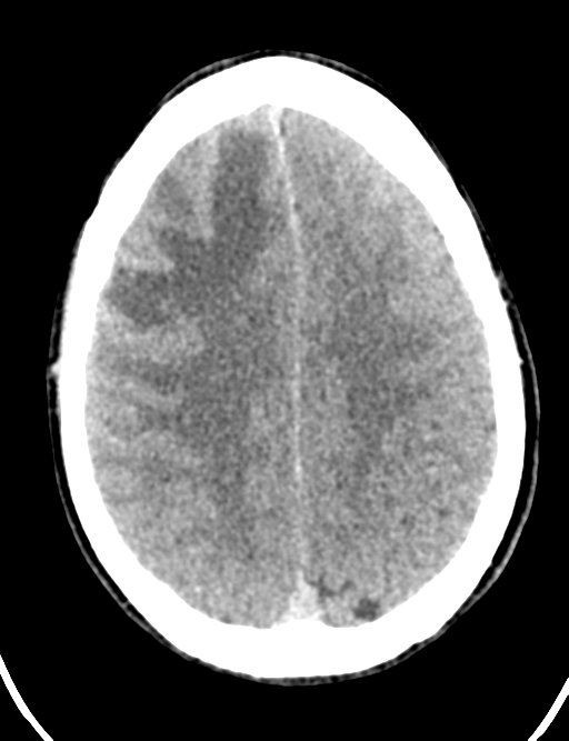Cerebral abscess (Radiopaedia 60342-68008 Axial non-contrast 38).png