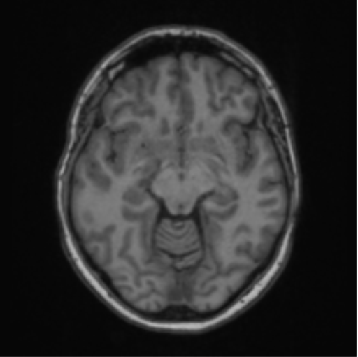 Cerebral abscess from pulmonary arteriovenous malformation (Radiopaedia 86275-102291 Axial T1 33).png
