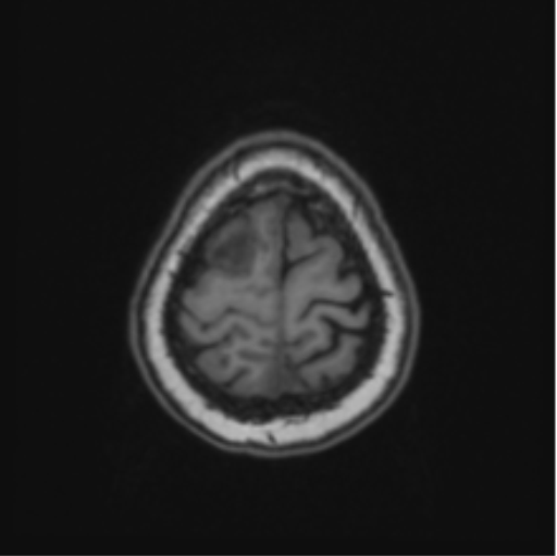 Cerebral abscess from pulmonary arteriovenous malformation (Radiopaedia 86275-102291 Axial T1 67).png