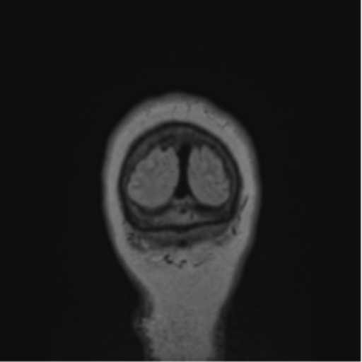 Cerebral abscess from pulmonary arteriovenous malformation (Radiopaedia 86275-102291 Coronal FLAIR 9).png