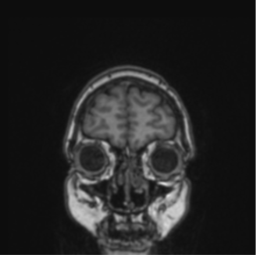 File:Cerebral abscess from pulmonary arteriovenous malformation (Radiopaedia 86275-102291 Coronal T1 79).png