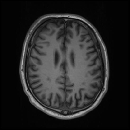 File:Cerebral abscess with ventriculitis (Radiopaedia 78965-91878 Axial T1 33).jpg