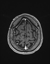 Cerebral amyloid angiopathy-related inflammation (Radiopaedia 58270-65377 Axial T1 C+ fat sat 129).jpg