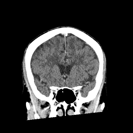 Cerebral amyloid angiopathy-related inflammation (Radiopaedia 74836-85848 Coronal non-contrast 26).jpg
