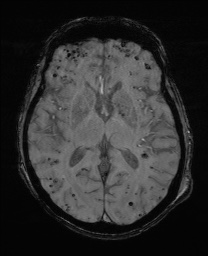 Cerebral amyloid angiopathy-related inflammation (Radiopaedia 74836-85849 Axial SWI 38).jpg