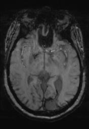 File:Cerebral amyloid angiopathy (Radiopaedia 29129-29518 Axial SWI Magnitude 16).jpg