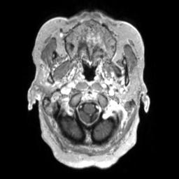 Cerebral amyloid angiopathy (Radiopaedia 29129-29518 Axial T1 C+ 19).jpg