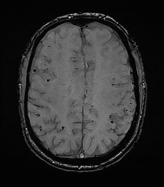 Cerebral amyloid angiopathy (Radiopaedia 46082-50433 Axial SWI 57).png