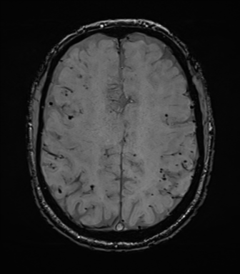 File:Cerebral amyloid angiopathy (Radiopaedia 46082-50433 Axial SWI 58).png