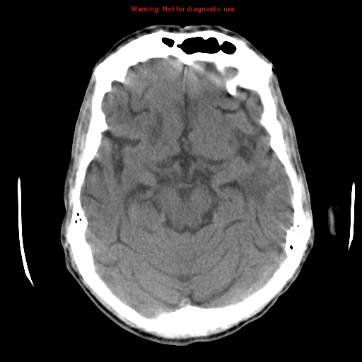 File:Cerebral and orbital tuberculomas (Radiopaedia 13308-13310 Axial non-contrast 11).jpg