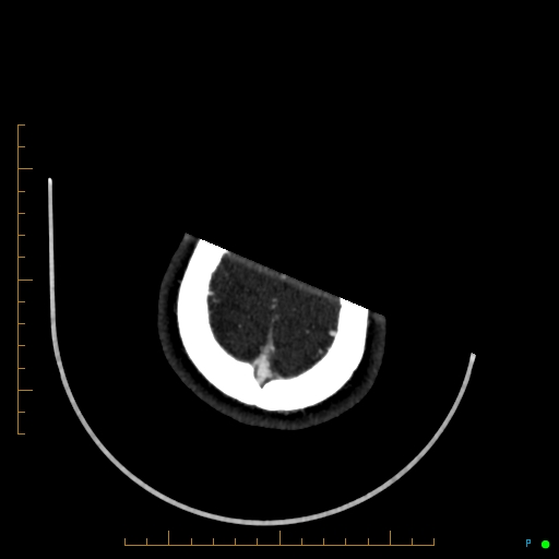Cerebral arteriovenous malformation (AVM) (Radiopaedia 78162-90706 Axial CTA 246).jpg