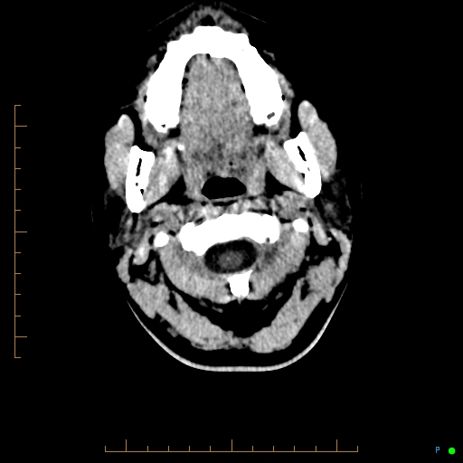 Cerebral arteriovenous malformation (AVM) (Radiopaedia 78162-90706 Axial non-contrast 1).jpg