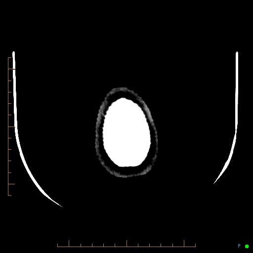 Cerebral arteriovenous malformation (AVM) (Radiopaedia 78162-90706 Axial non-contrast 64).jpg