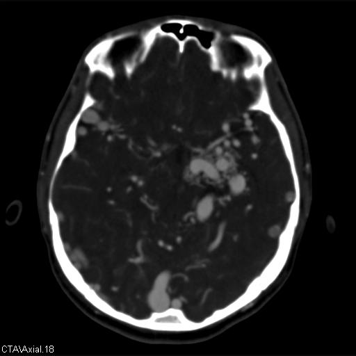 File:Cerebral arteriovenous malformation (Radiopaedia 28518-28759 B 18).jpg
