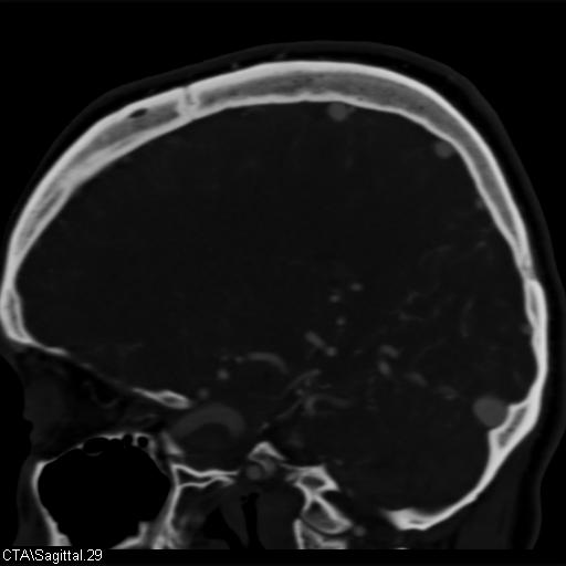 Cerebral arteriovenous malformation (Radiopaedia 28518-28759 D 26).jpg