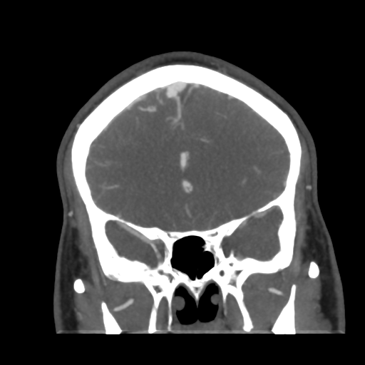 File:Cerebral arteriovenous malformation (Radiopaedia 39259-41505 E 22).png