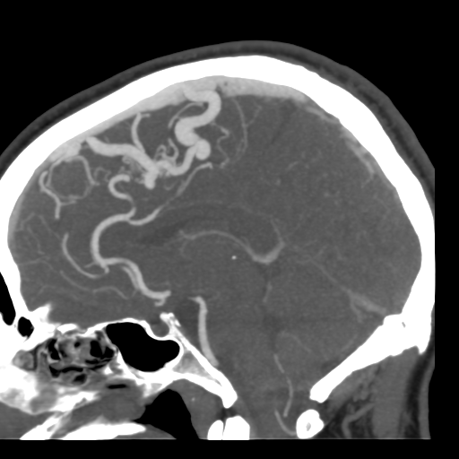 Cerebral arteriovenous malformation (Radiopaedia 39259-41505 Sagittal 30).png