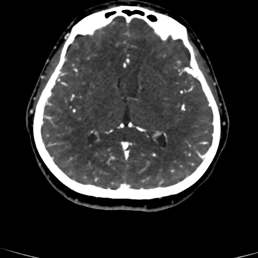Cerebral arteriovenous malformation (Radiopaedia 73830-84645 Axial C+ delayed 45).jpg
