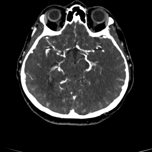 Cerebral arteriovenous malformation (Radiopaedia 73830-84645 Axial C+ delayed 54).jpg