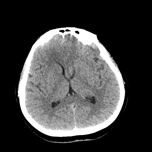 File:Cerebral arteriovenous malformation (Radiopaedia 73830-84645 Axial non-contrast 24).jpg