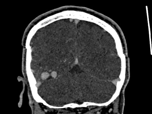 Cerebral arteriovenous malformation (Radiopaedia 78188-90746 Coronal C+ delayed 99).jpg