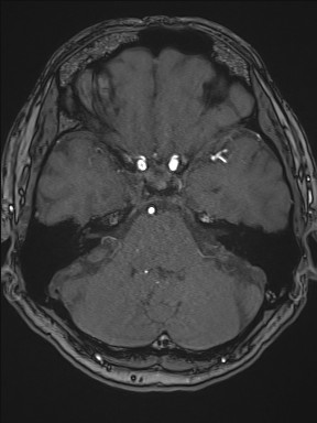 File:Cerebral arteriovenous malformation (Radiopaedia 84015-99245 Axial TOF 84).jpg