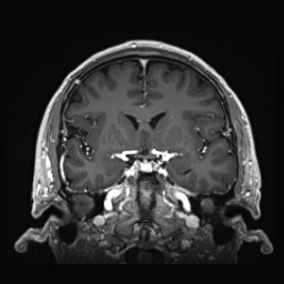 Cerebral arteriovenous malformation (Radiopaedia 84015-99245 Coronal T1 C+ 68).jpg