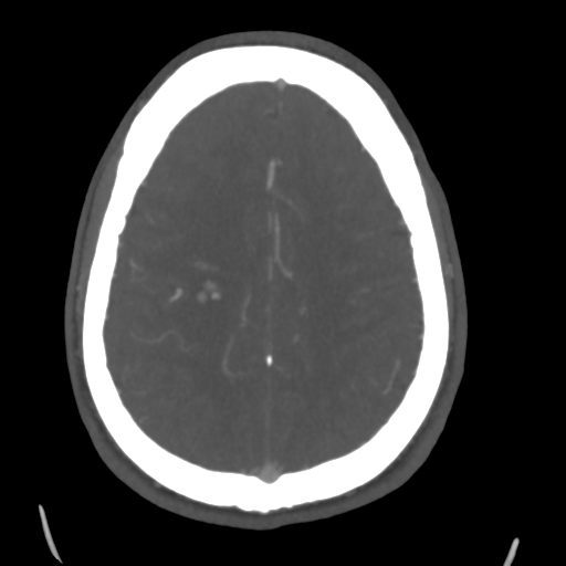 Cerebral arteriovenous malformation (Spetzler-Martin grade 2) (Radiopaedia 41262-44076 E 40).png