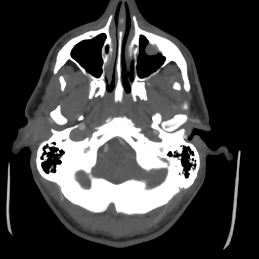 Cerebral arteriovenous malformation (Spetzler-Martin grade 2) (Radiopaedia 41262-44076 E 8).png