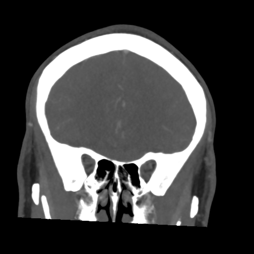 File:Cerebral arteriovenous malformation (Spetzler-Martin grade 2) (Radiopaedia 41262-44076 F 18).png