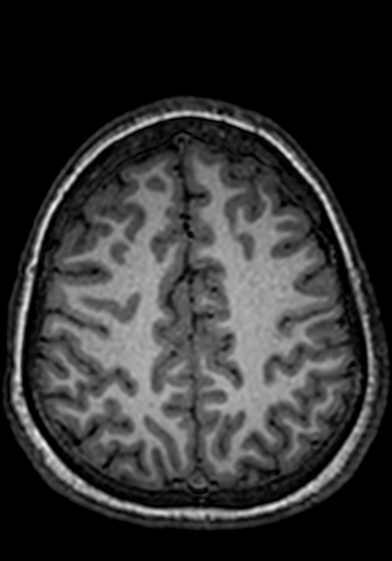 Cerebral arteriovenous malformation at posterior body of corpus callosum (Radiopaedia 74111-84925 Axial T1 64).jpg