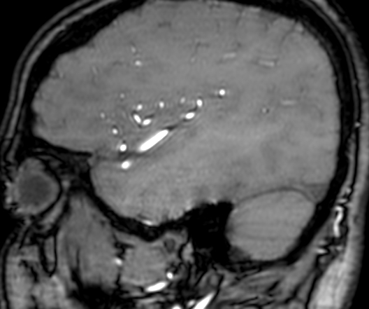 Cerebral arteriovenous malformation at posterior body of corpus callosum (Radiopaedia 74111-84925 J 320).jpg