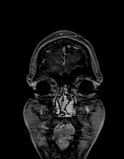 Cerebral arteriovenous malformation at posterior body of corpus callosum (Radiopaedia 74111-84925 K 14).jpg
