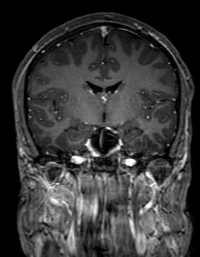 Cerebral arteriovenous malformation at posterior body of corpus callosum (Radiopaedia 74111-84925 K 174).jpg