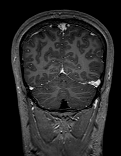 Cerebral arteriovenous malformation at posterior body of corpus callosum (Radiopaedia 74111-84925 K 300).jpg