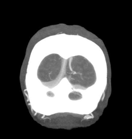 File:Cerebral arteriovenous malformation with lobar hemorrhage (Radiopaedia 44725-48511 B 53).png