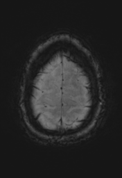 File:Cerebral cavernoma and development venous anomaly (Radiopaedia 37603-39482 Axial SWI 36).png