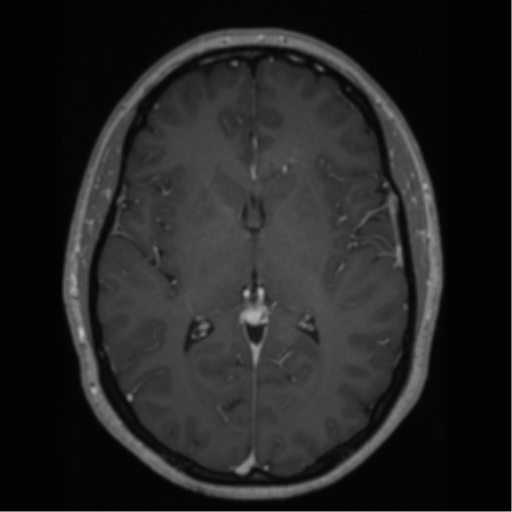 Cerebral cavernoma and development venous anomaly (Radiopaedia 37603-39482 Axial T1 C+ 40).png