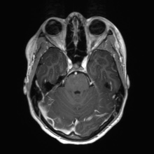Cerebral cavernous venous malformation (Radiopaedia 70008-80021 Axial T1 C+ 21).jpg