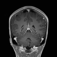File:Cerebral cavernous venous malformation (Radiopaedia 70008-80021 Coronal T1 C+ 22).jpg