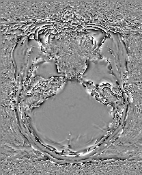 Cerebral cavernous venous malformation (Radiopaedia 70008-80021 G 19).jpg