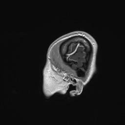 Cerebral cavernous venous malformation (Radiopaedia 70008-80021 Sagittal T1 C+ 3).jpg