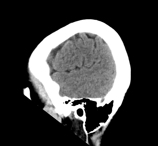 File:Cerebral cavernous venous malformations (Radiopaedia 48117-52945 C 6).png