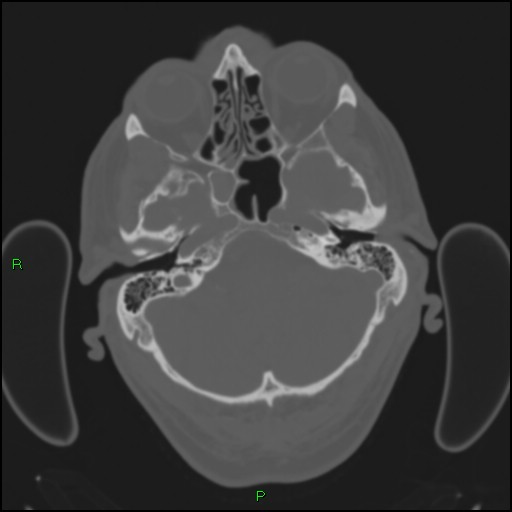 Cerebral contusions (Radiopaedia 33868-35039 Axial bone window 38).jpg