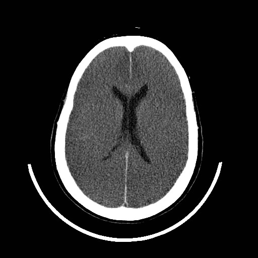 File:Cerebral edema (evolution in time) (Radiopaedia 19418-19439 non-contrast 59).jpg