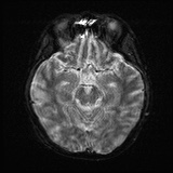 Cerebral embolic infarcts (embolic shower) (Radiopaedia 72391-82921 Axial DWI 11).jpg